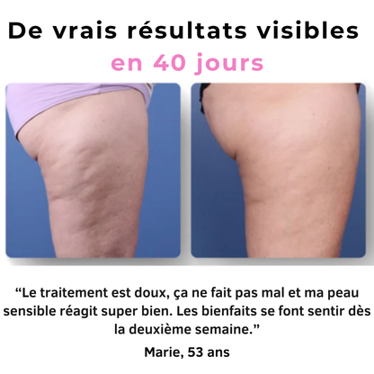 Zyricx™ Masseur Anti-Cellulite