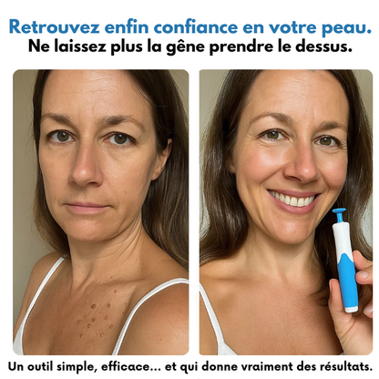 Zyricx™ Kit Complet – Fini les Excroissances Cutanées